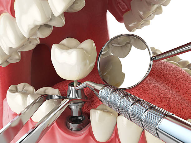 Best Chipped Tooth Repair Near Me  in Bloomingdale, GA